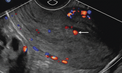 erken-gebelik-renkli-doppler